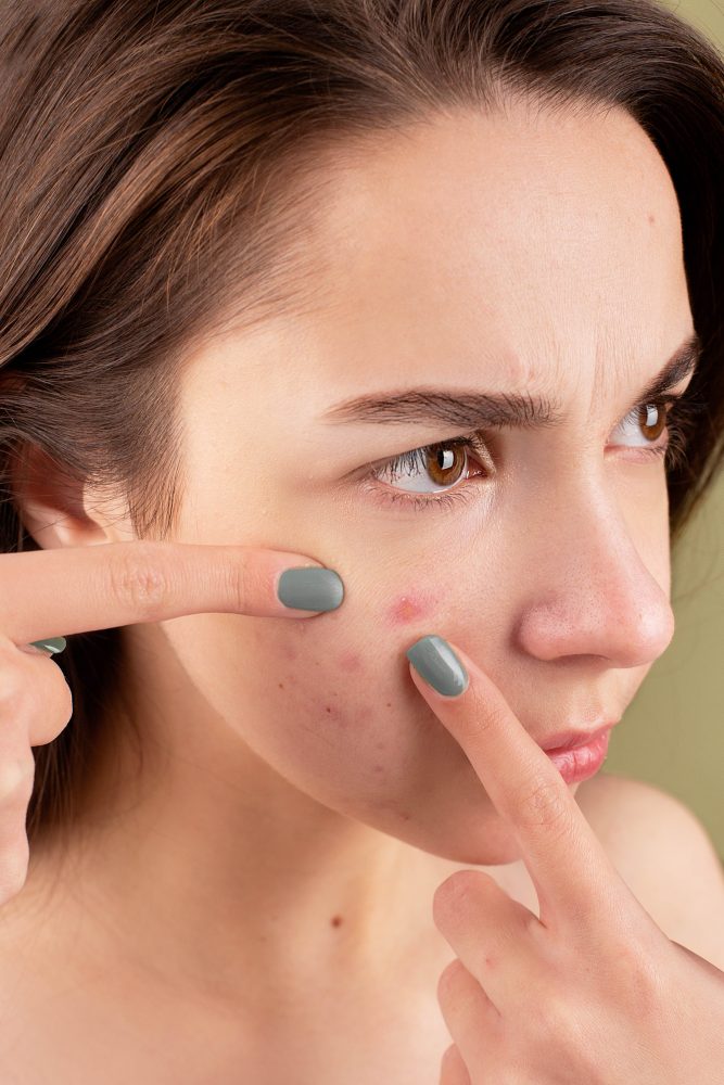 Woman squeezing her pimples with her fingers